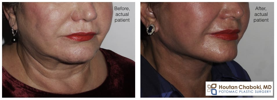 Blog post - before after facelift photo neck lift cosmetic facial surgery beauty