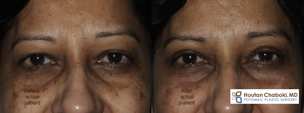 Blog post - before after upper eyelid plastic surgery excess skin