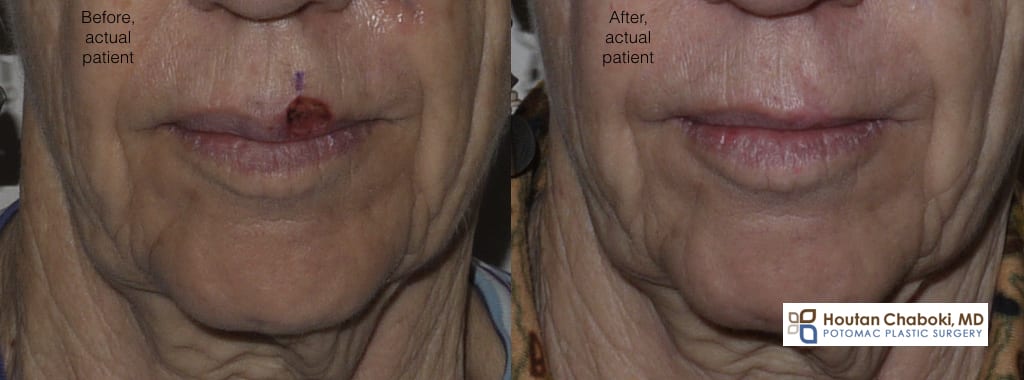 Blog post - before after lip skin cancer surgery MOHS