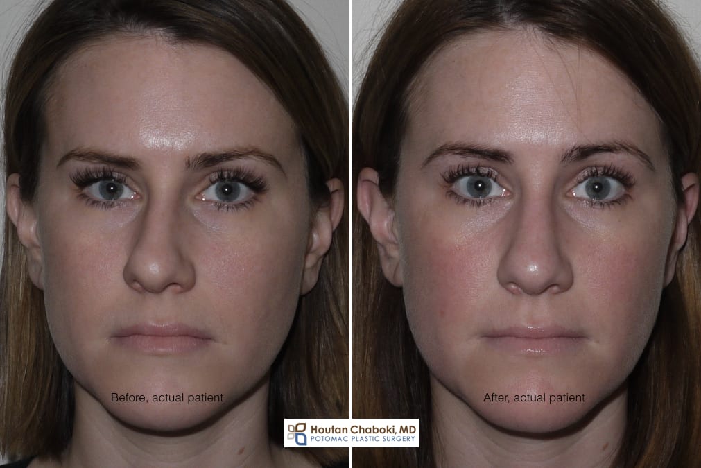 Blog post - before after rhinoplasty photos bone reshaping osteotomy DC