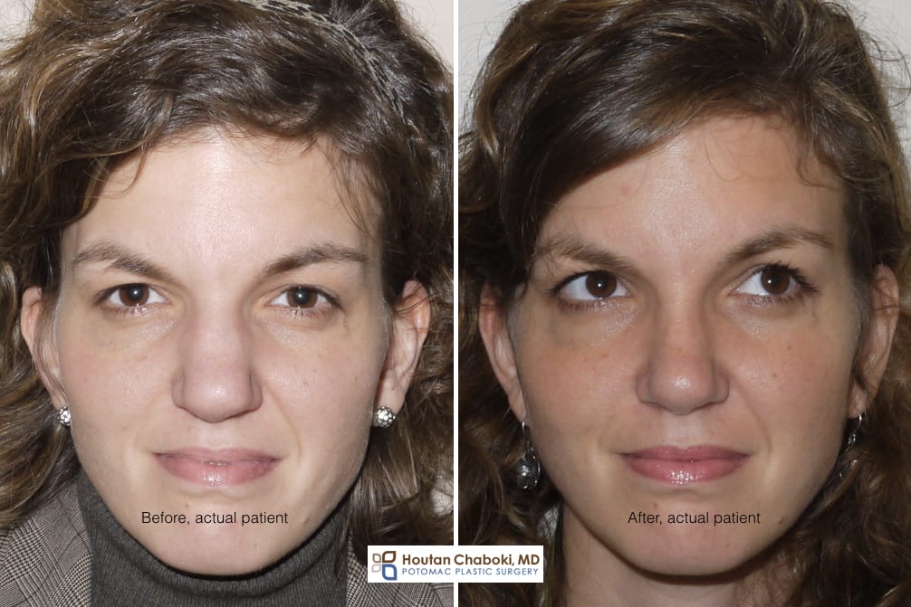 Blog post - before after rhinoplasty photos bone reshaping osteotomy DC