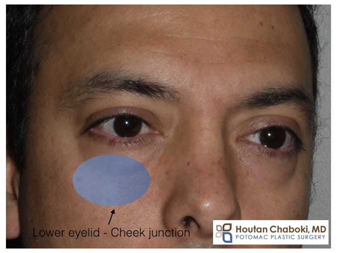 Blog post - photo before after lower eyelid cheek junction plastic surgery