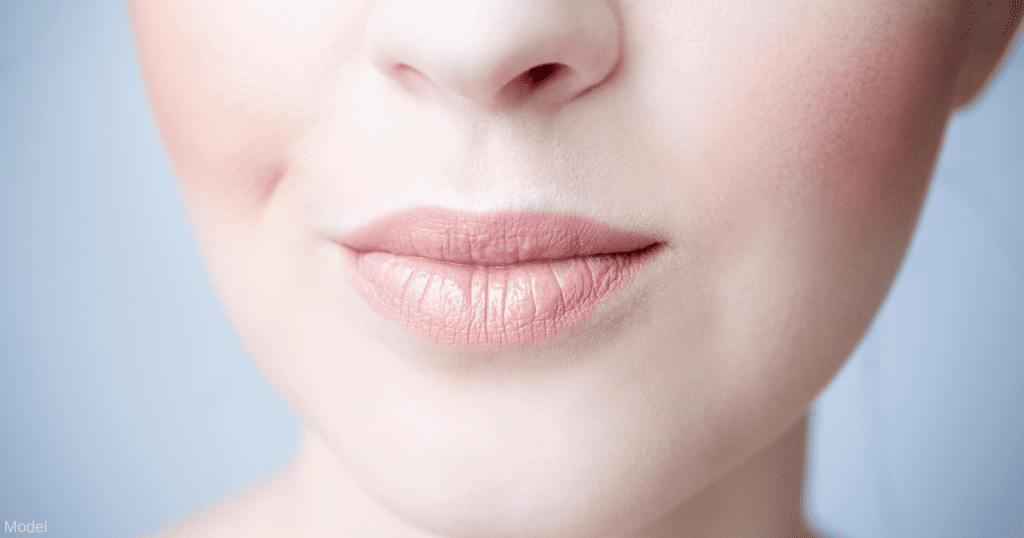 Upper lip lift surgery is better than injections for a long lip