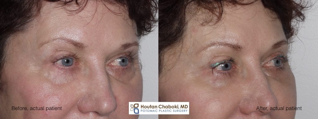 Blog post - before after photos facial filler Restylane tear trough cheek eyelid