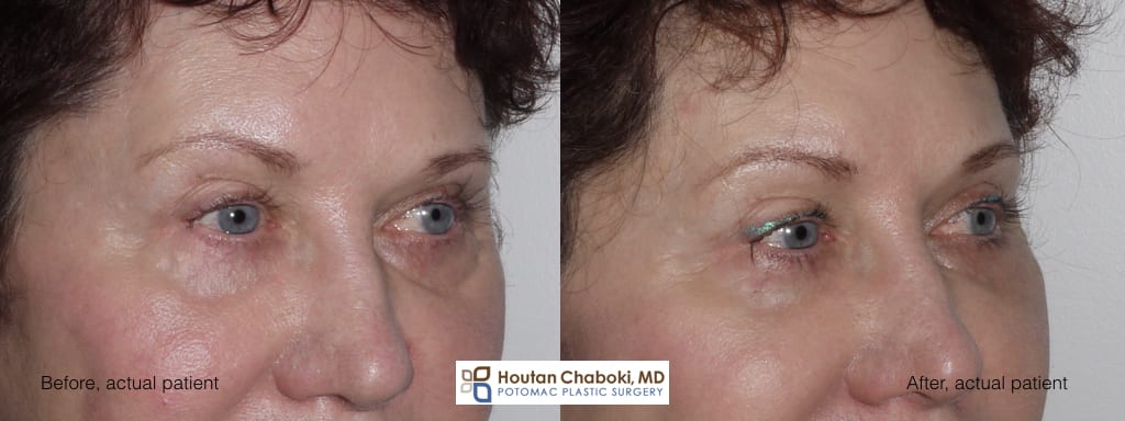 Blog post - before after photos facial filler Restylane tear trough cheek eyelid