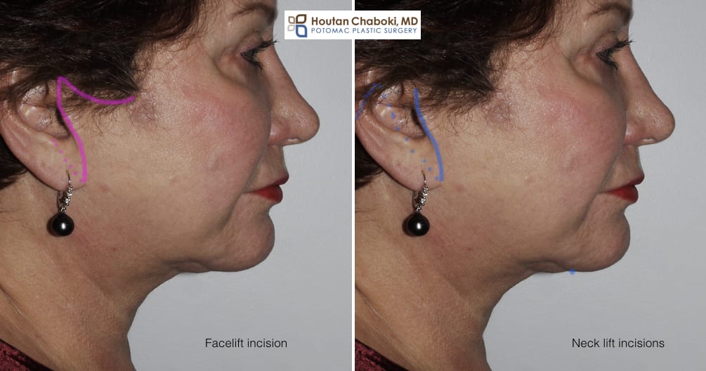 Blog post - facelift neck lift incisions cosmetic surgery