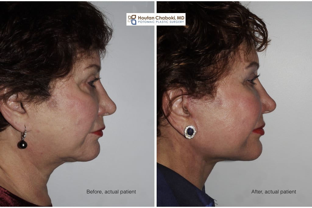 Blog post - facelift neck lift incisions cosmetic surgery