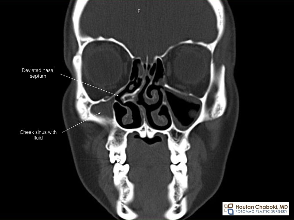 Blog post - CT scan sinus deviated septum bone spur rhinoplasty DC