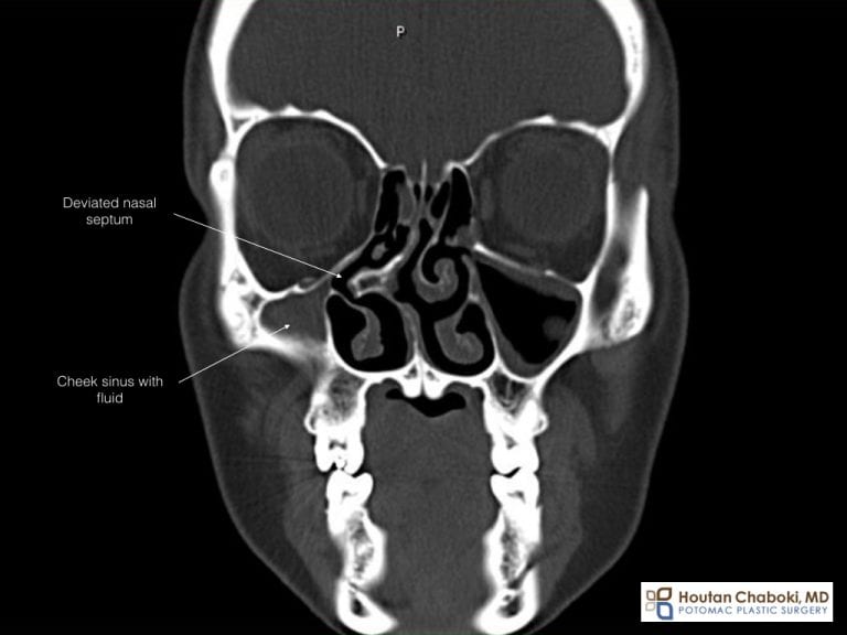 Rhinoplasty and Septoplasty for Bone Spur