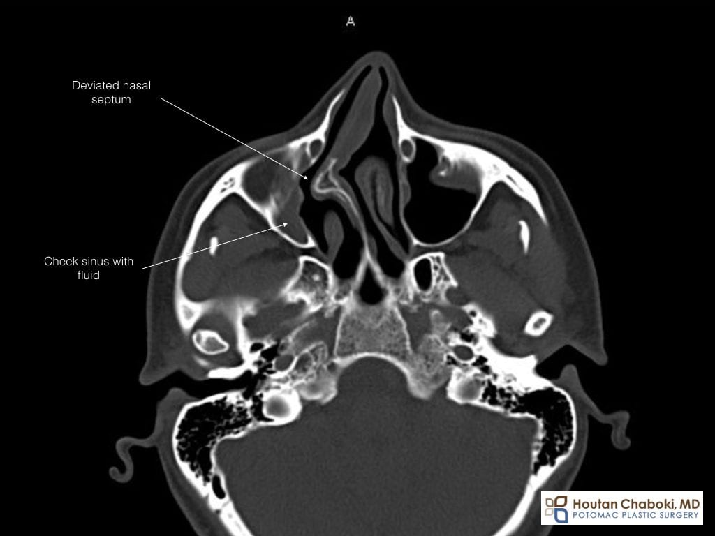 Blog post - CT scan sinus deviated septum bone spur rhinoplasty DC