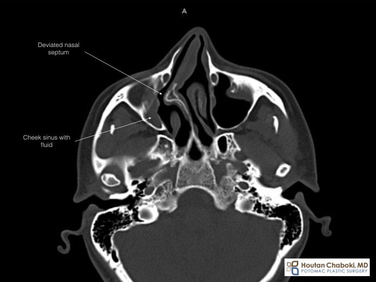 Rhinoplasty and Septoplasty for Bone Spur