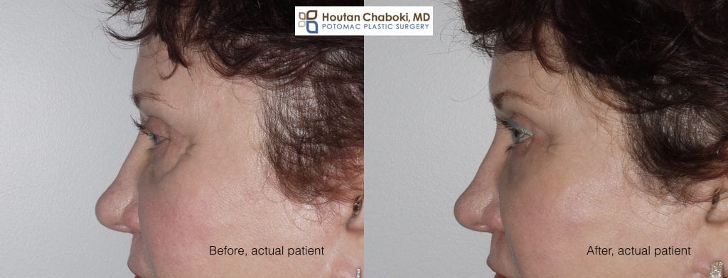 Blog post - before after liquid facelift photos facial filler eyelid cheek