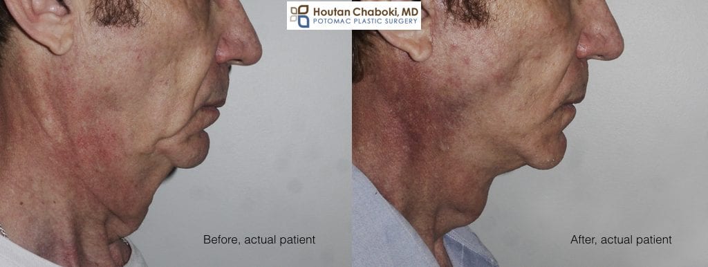 Blog post - before after male facelift neck lift photos