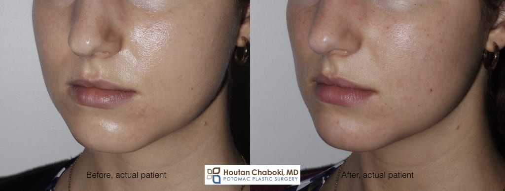 Slimming The Face With Cheek Fat Reduction - Potomac Plastic Surgery