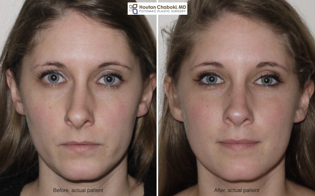 Blog post - before after broken nose repair septoplasty rhinoplasty front view