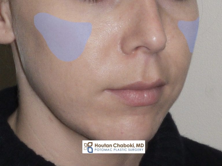 Silicone implants for Cheek Augmentation Potomac Plastic Surgery