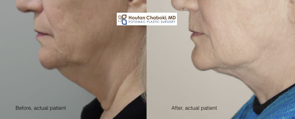 Blog post - before after photo neck lift liposuction smoking