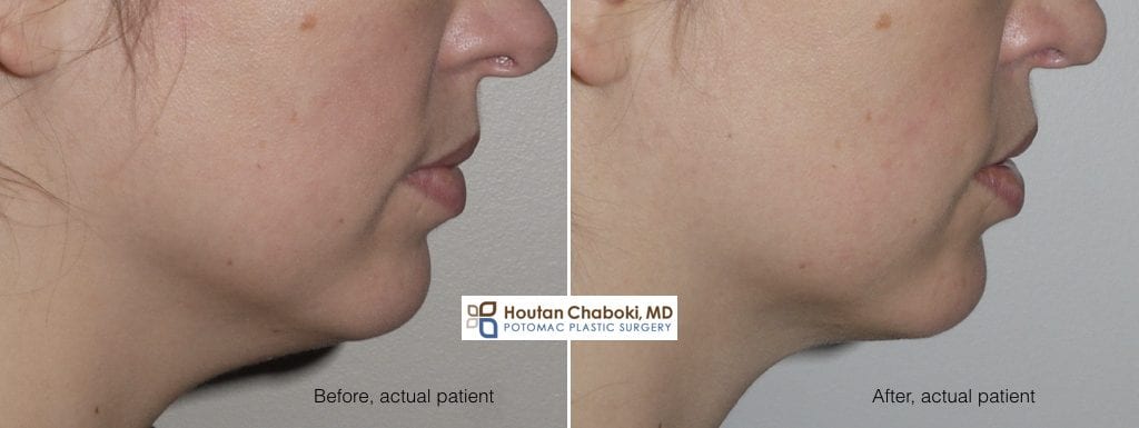 Blog post - before after photos double chin neck liposuction
