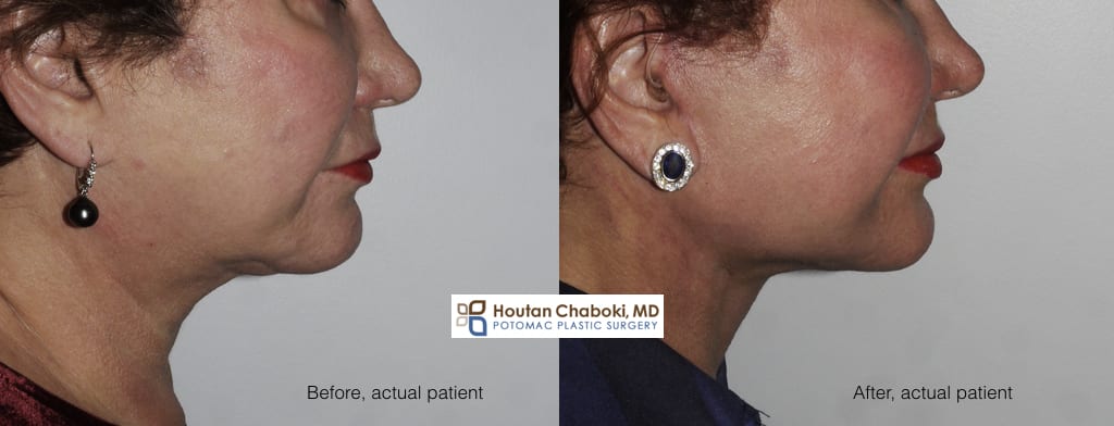 Blog post - before after photos double chin neck liposuction