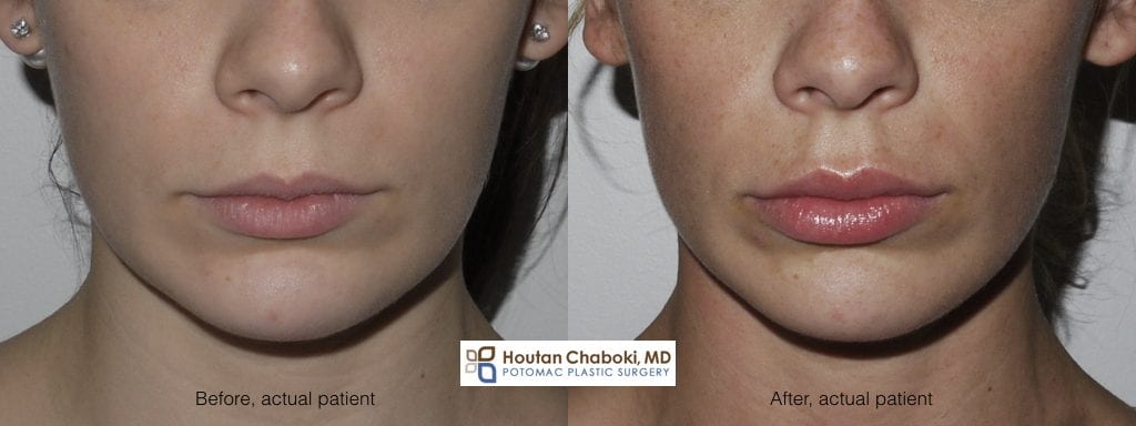 Blog post - before after lip injection photos Juvederm Botox swelling