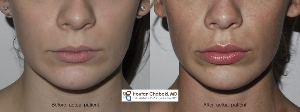 how to reduce facial swelling after plastic surgery