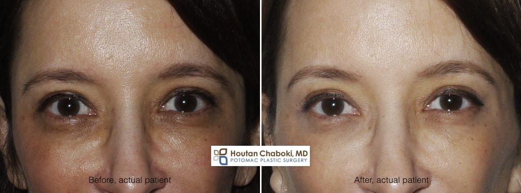 Blog post - before after photo Botox Dysport brow lift wrinkle face