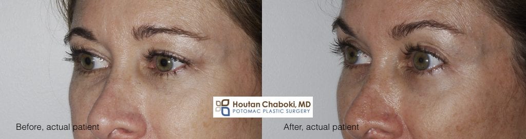 Blog post - before after photos Botox brow lift wrinkle skin antiaging Crow