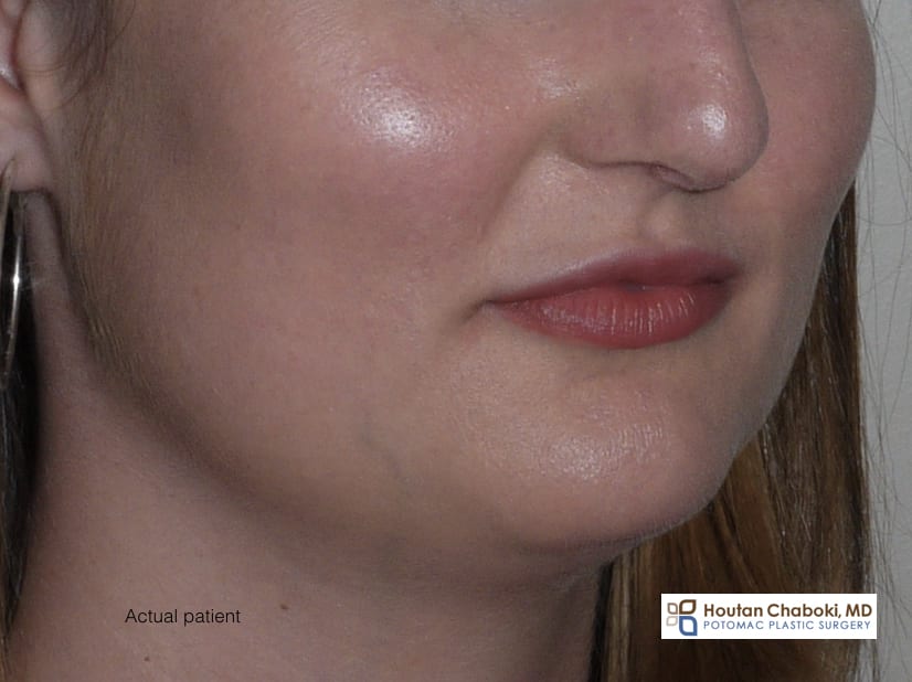 Blog post - photos healthy skin peel laser resurface smooth