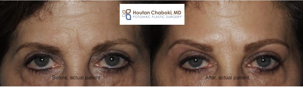 Blog post - before after Botox brow lift wrinkle forehead eyes facial plastic surgery