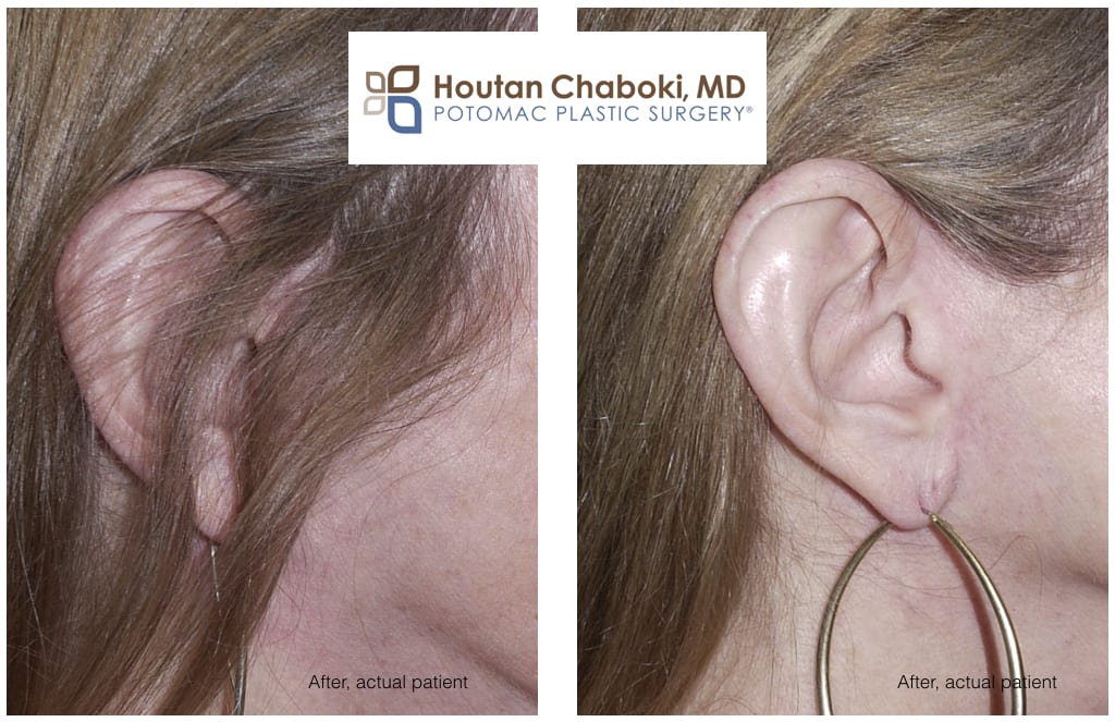 Blog post - before after facelift scar swelling bruising hide recovery