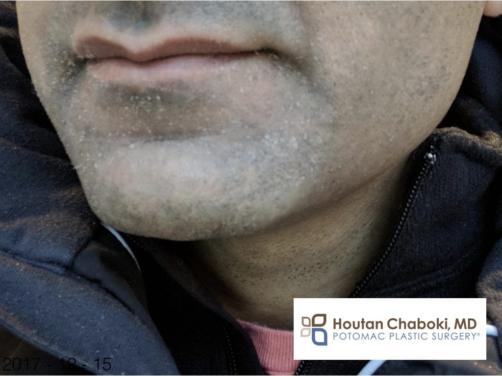 Blog post - dry winter skin flaking itchy plastic surgery dermatology