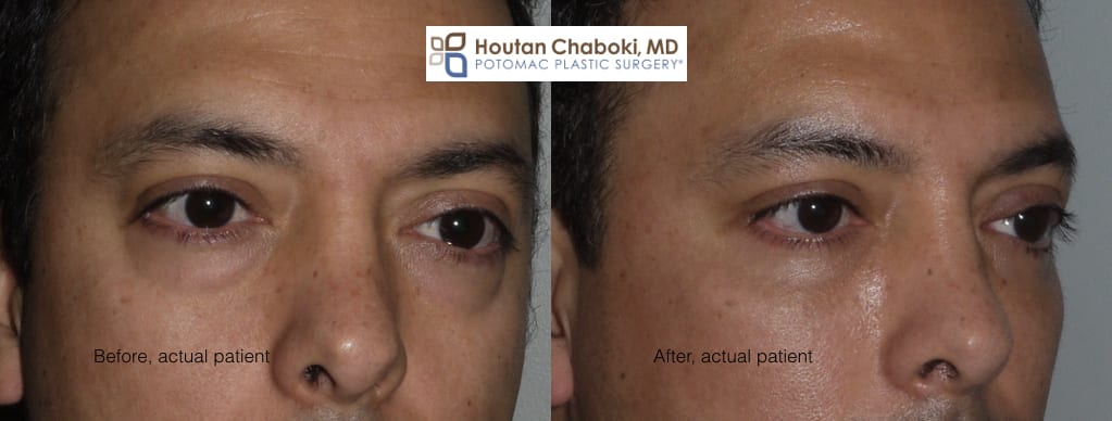 Blog post - lower eyelid bag dark circle facial filler blepharoplasty fat transfer