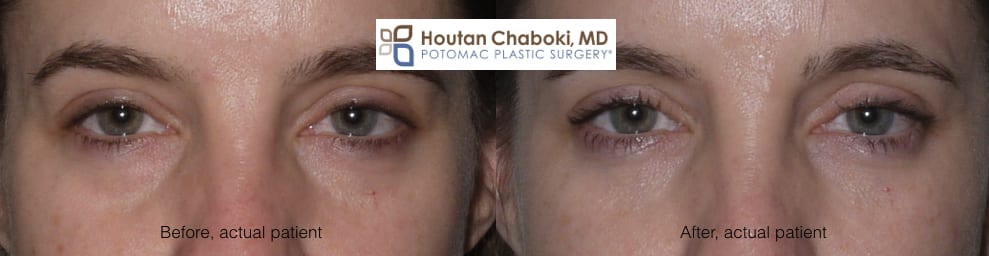 Blog post - lower eyelid bag dark circle facial filler blepharoplasty fat transfer