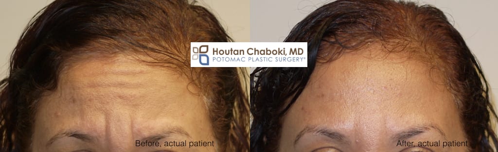 Blog post - before after Botox forehead lines wrinkles facial filler