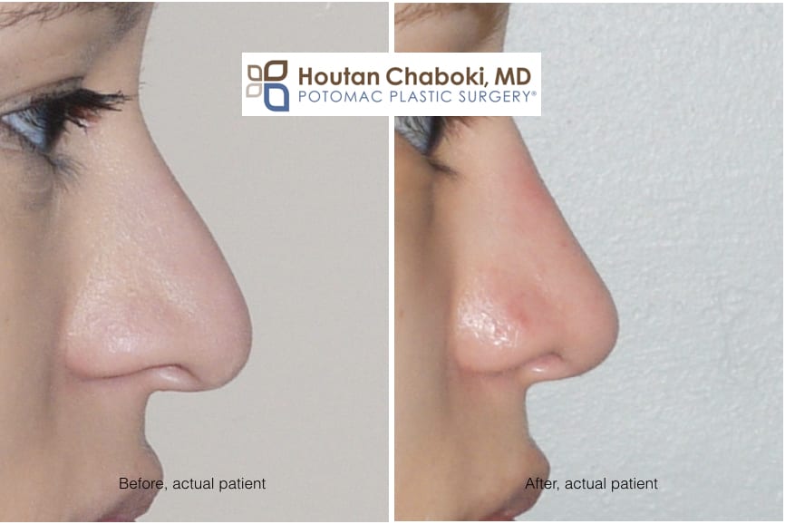 Blog post - before after closed rhinoplasty septoplasty open revision