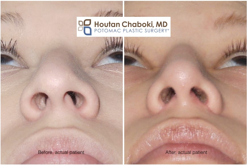 Blog post - before after closed rhinoplasty septoplasty open revision