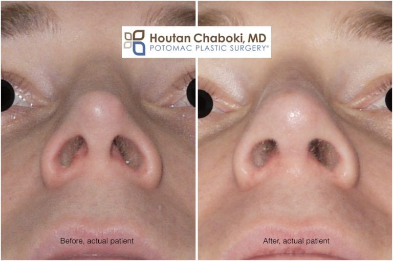 Open vs. Closed Rhinoplasty - Which is better?