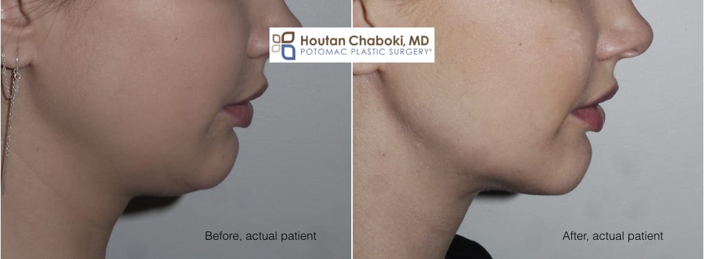 Blog post - before after neck lift facelift liposuction chin implant jawline double chin