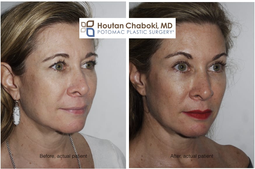 Blog post - before after photos cheek augmentation facial filler Voluma Juvederm facial plastic surgery