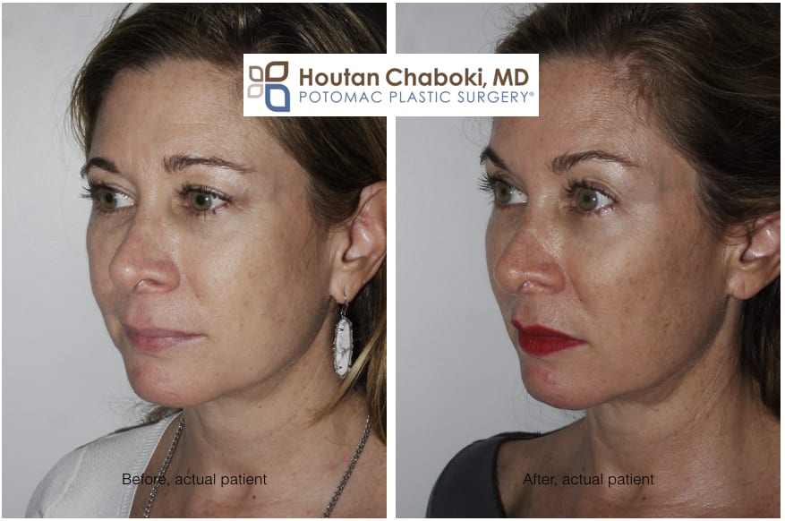 Blog post - before after photos cheek augmentation facial filler Voluma Juvederm facial plastic surgery