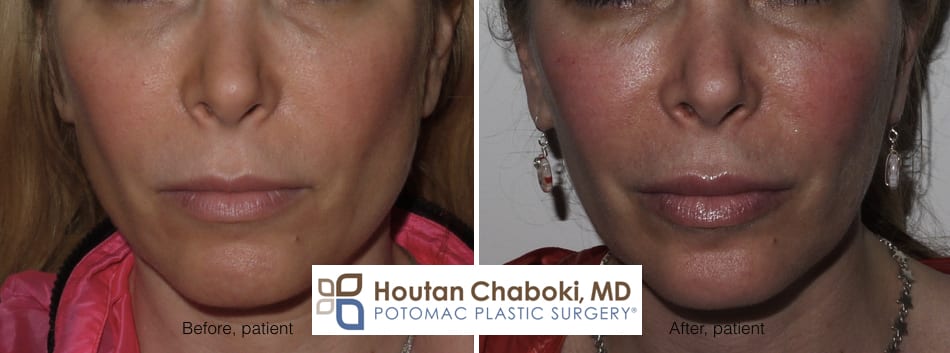 Blog post - before after photos Botox jaw reduction facial sculpting masseter muscle Dysport