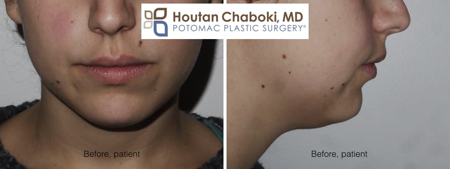 Blog post - before after photos chin surgery neck lift mentalis muscle dimple