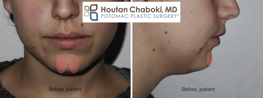Blog post - before after photos chin surgery neck lift mentalis muscle dimple