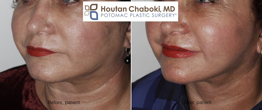 Blog post - before after photos fat transfer lips cheek facelift neck