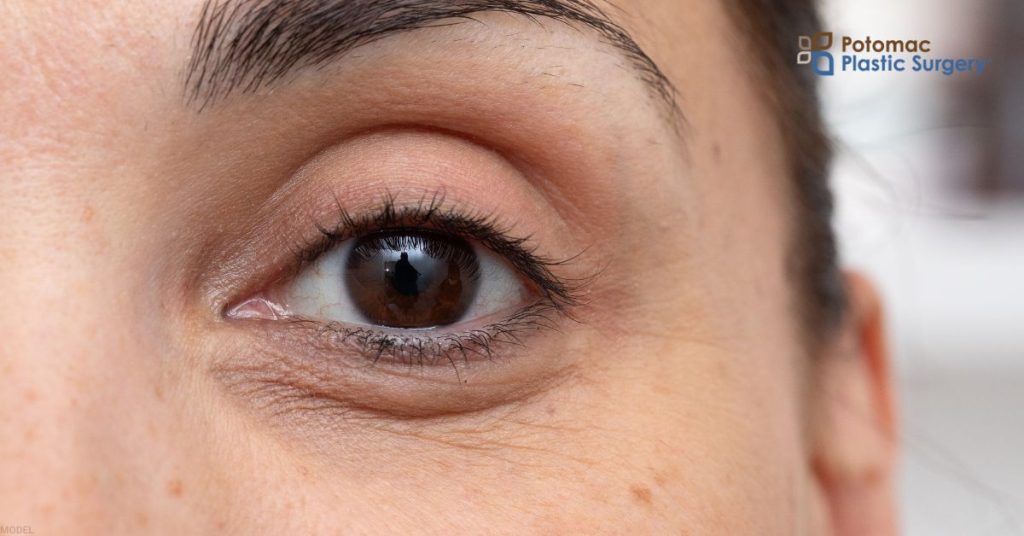 Woman's eye post eyelid surgery (model)