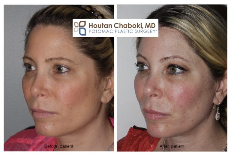 how to reduce facial swelling after plastic surgery