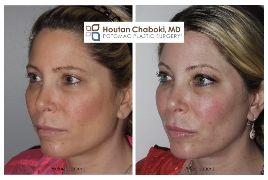 Blog post - before after photo facial filler Juvederm Volume Restylane cheek lip swelling liquid lift