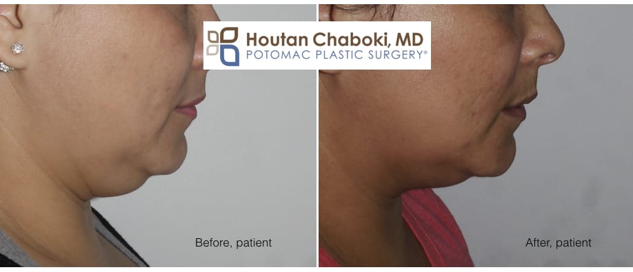 Blog post - before after photos Kybella neck fat liposuction lift plastic surgery