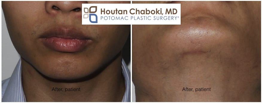 Blog post - before after photos chin augmentation silicone implant scar incision external