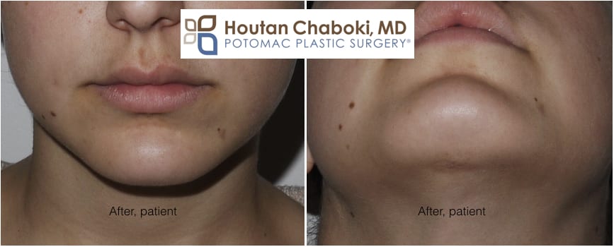 Blog post - before after photos chin augmentation silicone implant scar incision external